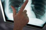 Boom di adenocarcinoma polmonare: colpa delle sigarette light