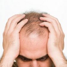 Alopecia androgenetica: sintomo di iperplasia prostatica benigna
