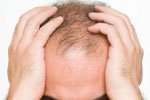 Alopecia androgenetica: sintomo di iperplasia prostatica benigna