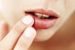 Herpes simplex: consigli alimentari contro l’herpes alle labbra