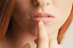 Prevenire l’herpes labiale: consigli contro l’herpes alle labbra